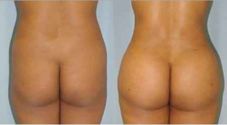 Ягодицы после пластики пластика