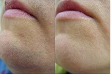 Рост волос рост