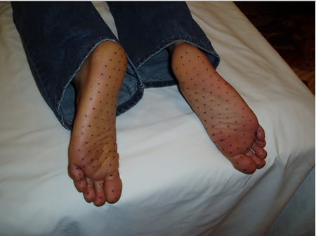 ботокс в стопы