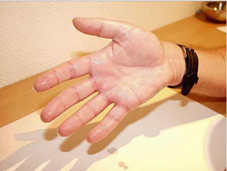 Инъекции ботокса ботокс в ладони