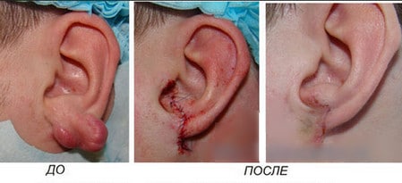 убрать рубцы практически полностью до и после