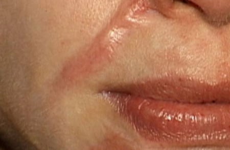 появление рубцов рубцы