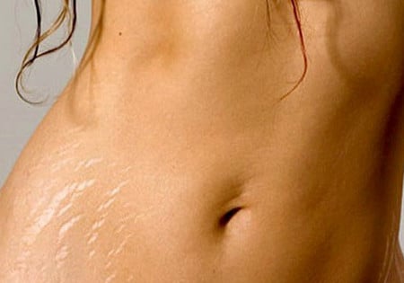 стрии после беременности