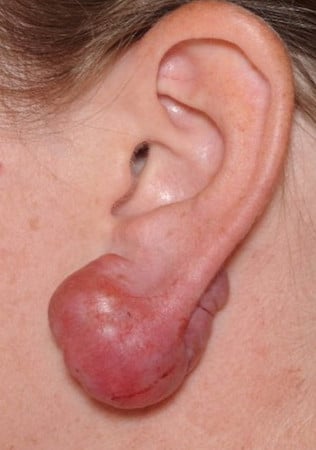 после пирсинга у халатных «мастеров» последствия пирсинга