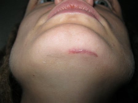 Келоид в начальной стадии полностью излечивается начальная стадия