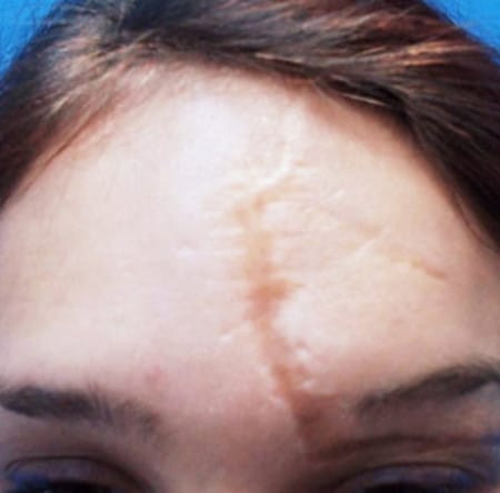 Келоидный рубец до иссечения до иссечения