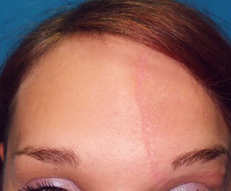 Келоидный рубец после иссечения после