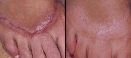 Удаление рубцов оперативным методом оперативный метод