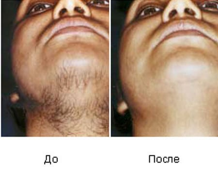 Полное уничтожение волос уничтожение волос