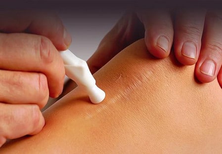 Лазерное удаление растяжек удаление растяжек