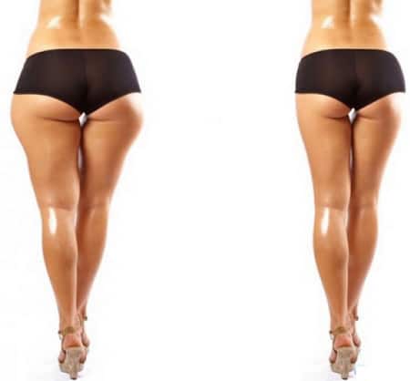 стройные бедра процедура липосакции