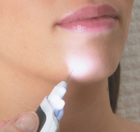 электроэпиляция