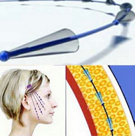 Разрезы делаются в височной области процедура лифтинга