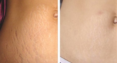 до и после после процедуры