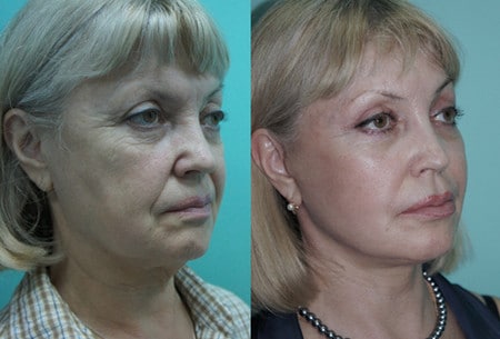 до и после липофилинга носогубных складок результаты липофилинга