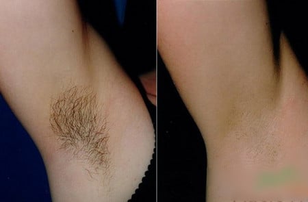 результат эпиляции