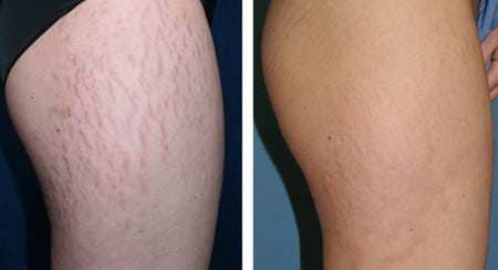 убрать застарелые растяжки воздействие эпиляции