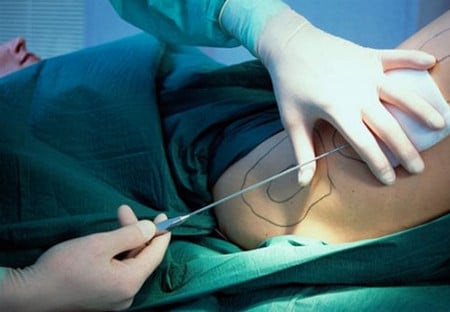 забор материала для пересадки забор материала