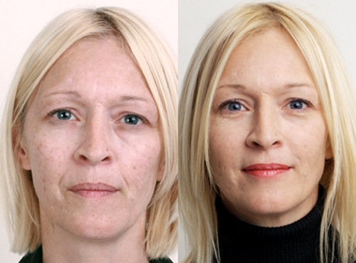 Лицо ДО и ПОСЛЕ до и после процедуры