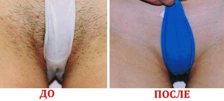 Лазерная эпиляция области бикини до и после