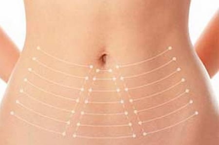 Нитевой лифтинг используют не только для подтяжки лица подтяжка живота