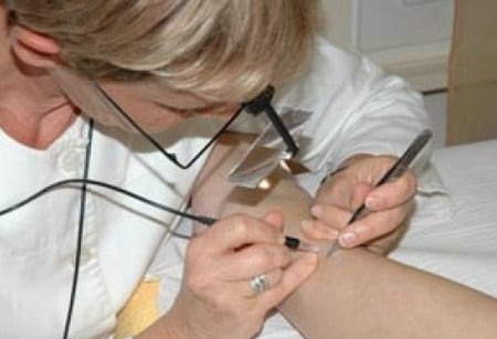 Успех электроэпиляции целиком и полностью зависит от врача показания к применению