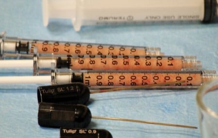 забор жировых клеток процедура липофилинга