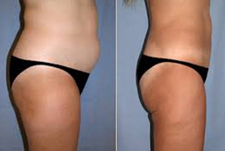 липомоделирование