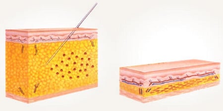 удаление жира