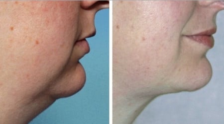 второй подбородок