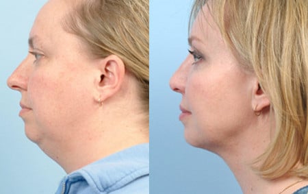 отличный результат кому доверить липосакцию