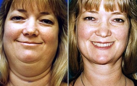 Убрать двойной подбородок при помощи липосакции коррекция лица