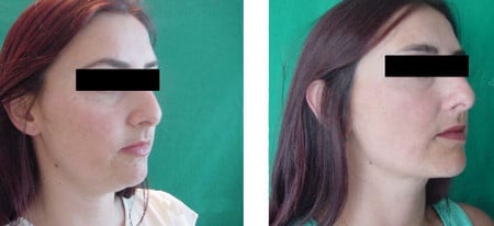 Лазерная липосакция подтянутый контур лица