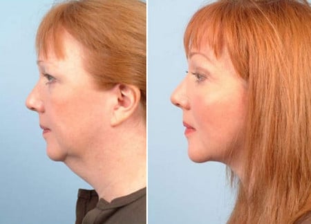 разглаживаются морщинки, изменяется контур лица после липосакции