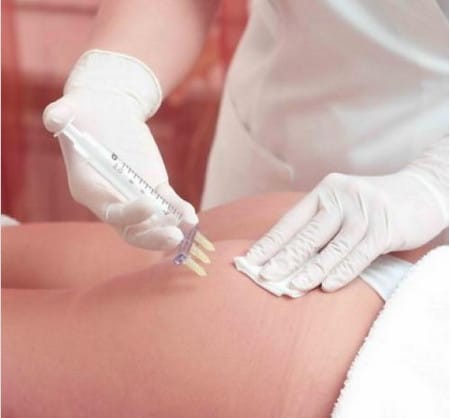 «Уколы стройности» мезотерапия