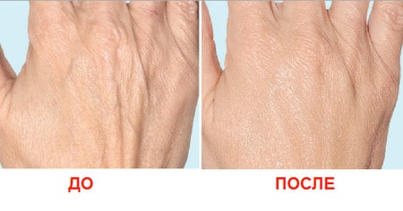 видимый подтягивающий эффект действие мезотерапии