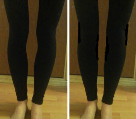 форма ног до и после