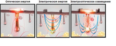 Элос эпиляция сплав