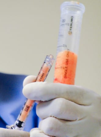 собственная жировая ткань «передислоцируется» на проблемное место липофилинг