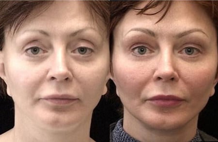 Проведение липофилинга верхних век после операции