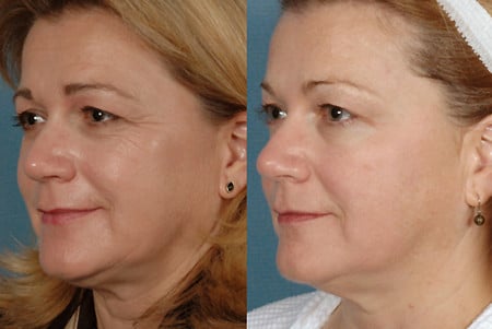Результаты омоложения Элос удаление мимических морщин