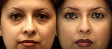 Липофилинг нижних век липофилинг век