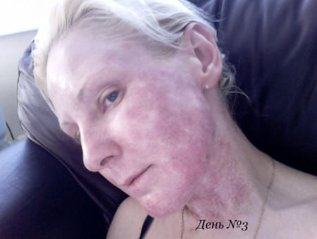 С таким лицом вам придется ходить около двух недель, а то и более после процедуры