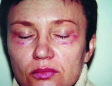 Неудачное введение иглы может привести к обширным гематомам гематомы