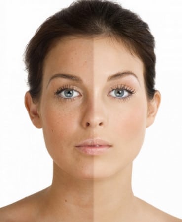 Химический пилинг результат ошеломляет