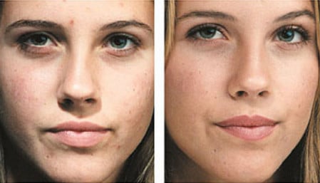 Поверхностный пилинг до и после