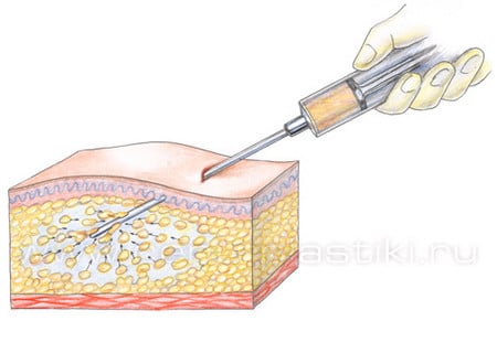 Забор жировой ткани жировая ткань