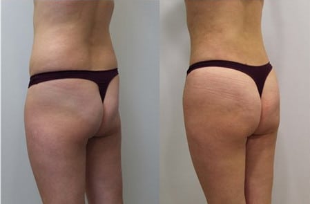 Липофилинг ягодиц пышные формы