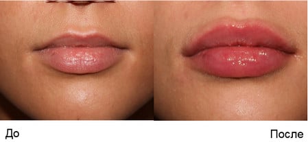 Ассиметричность губ ассиметричность