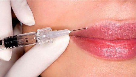 Липофилинг губ исключает возможность отторжения донорских тканей отторжение